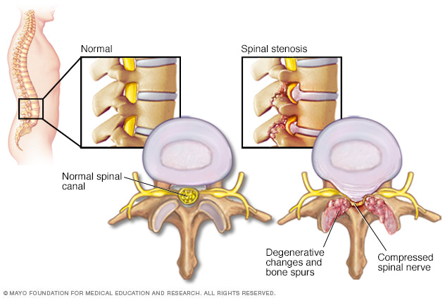 Spinal Canal Stenosis .jpg